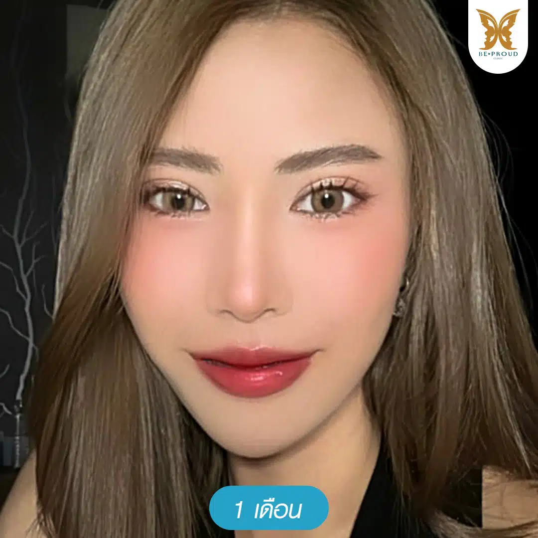 ภาพรีวิวตาสองชั้นแก้ปัญหาชั้นตาหลบใน หลังทำ 1 เดือน ที่บีพราวด์คลินิก