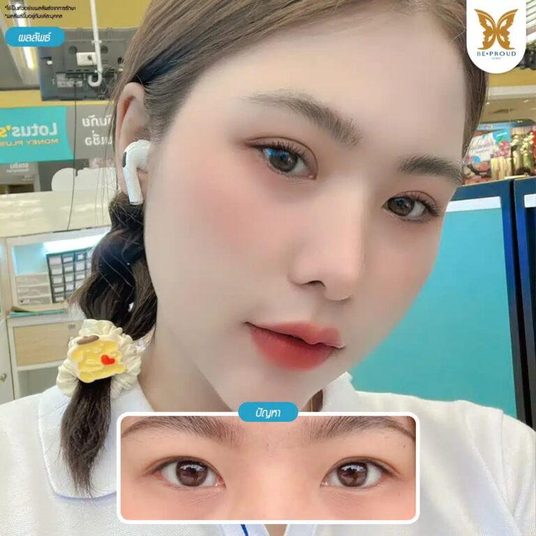 แก้กล้ามเนื้อตาอ่อนแรง