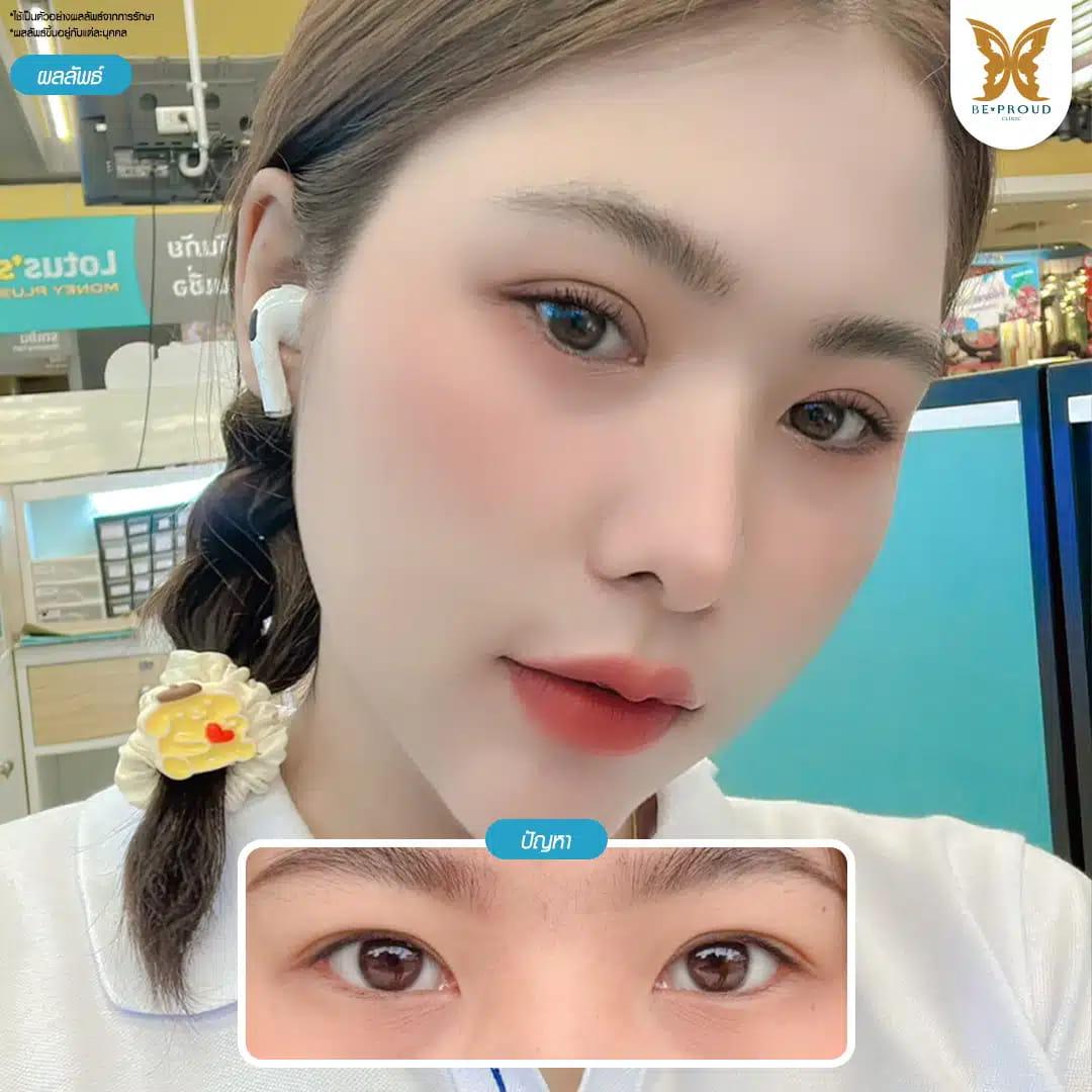 แก้กล้ามเนื้อตาอ่อนแรง