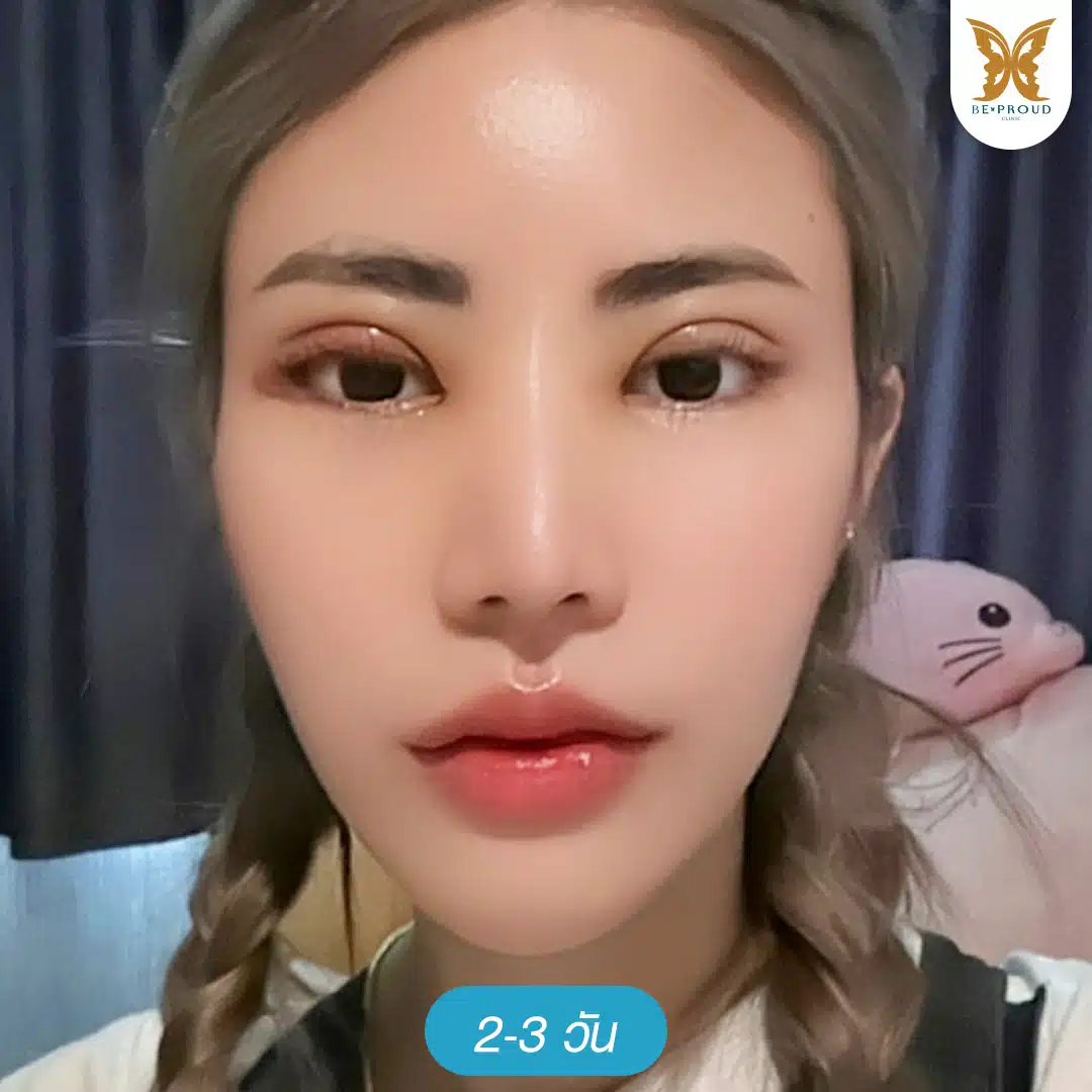 ภาพรีวิวตาสองชั้นแก้ปัญหาชั้นตาหลบใน หลังทำ 2-3 วัน มีอาการบวมเล็กน้อย ที่บีพราวด์คลินิก