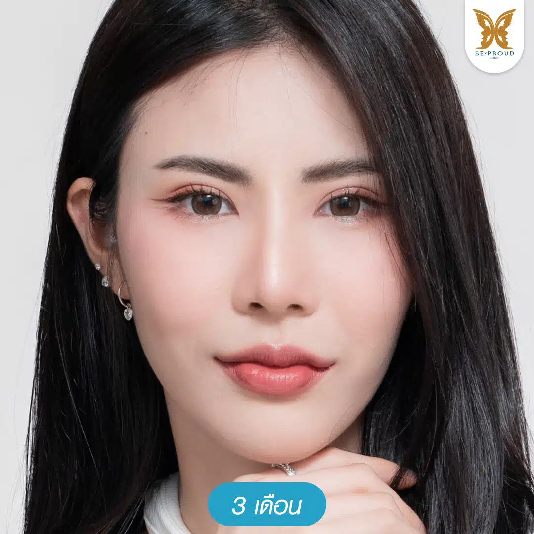 ภาพรีวิวตาสองชั้นแก้ปัญหาชั้นตาหลบใน หลังทำ 3 เดือน ชั้นตาคมชัด สวยเป็นธรรมชาติ ที่บีพราวด์คลินิก
