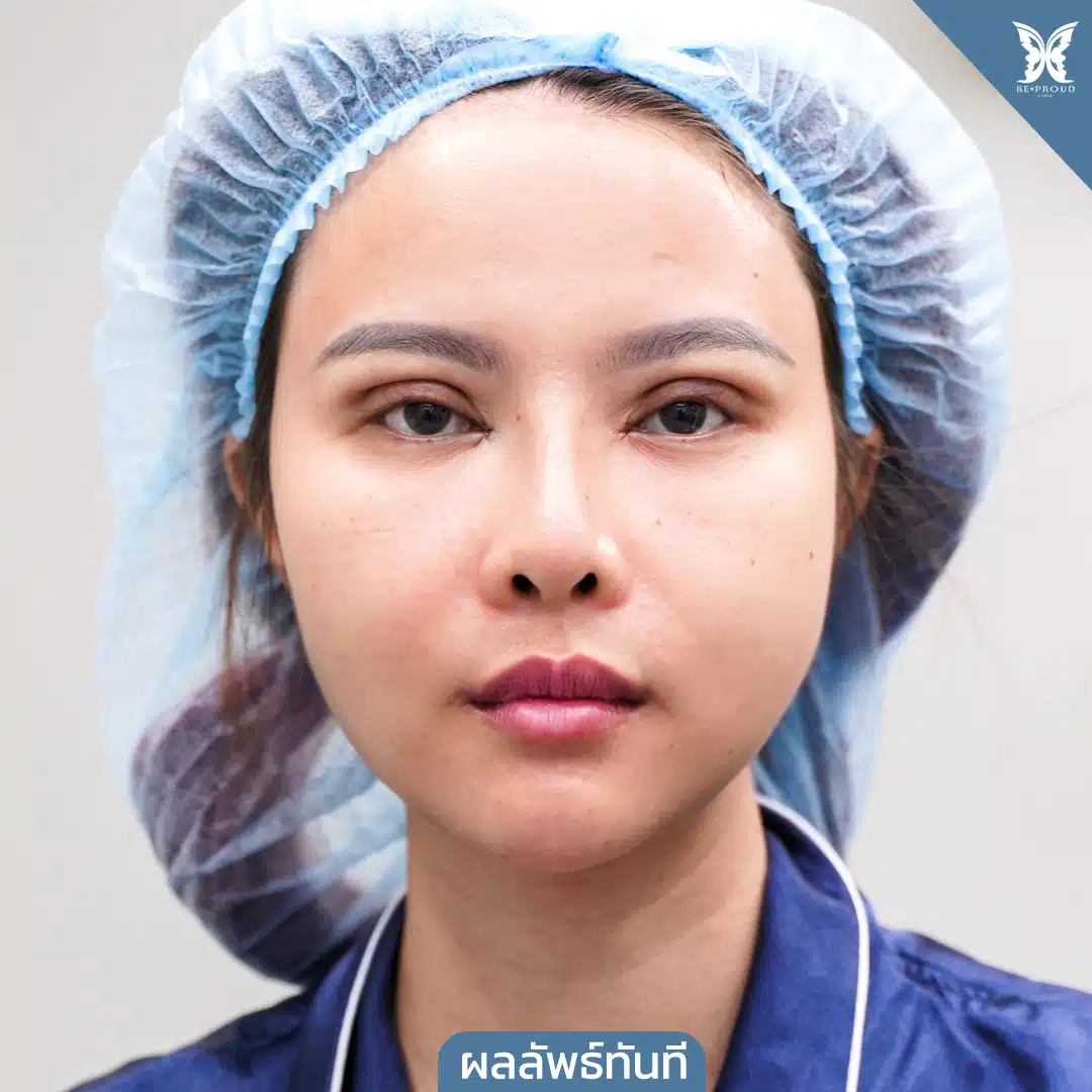 ตาสองชั้นกรีดตายาวแผลมินิ