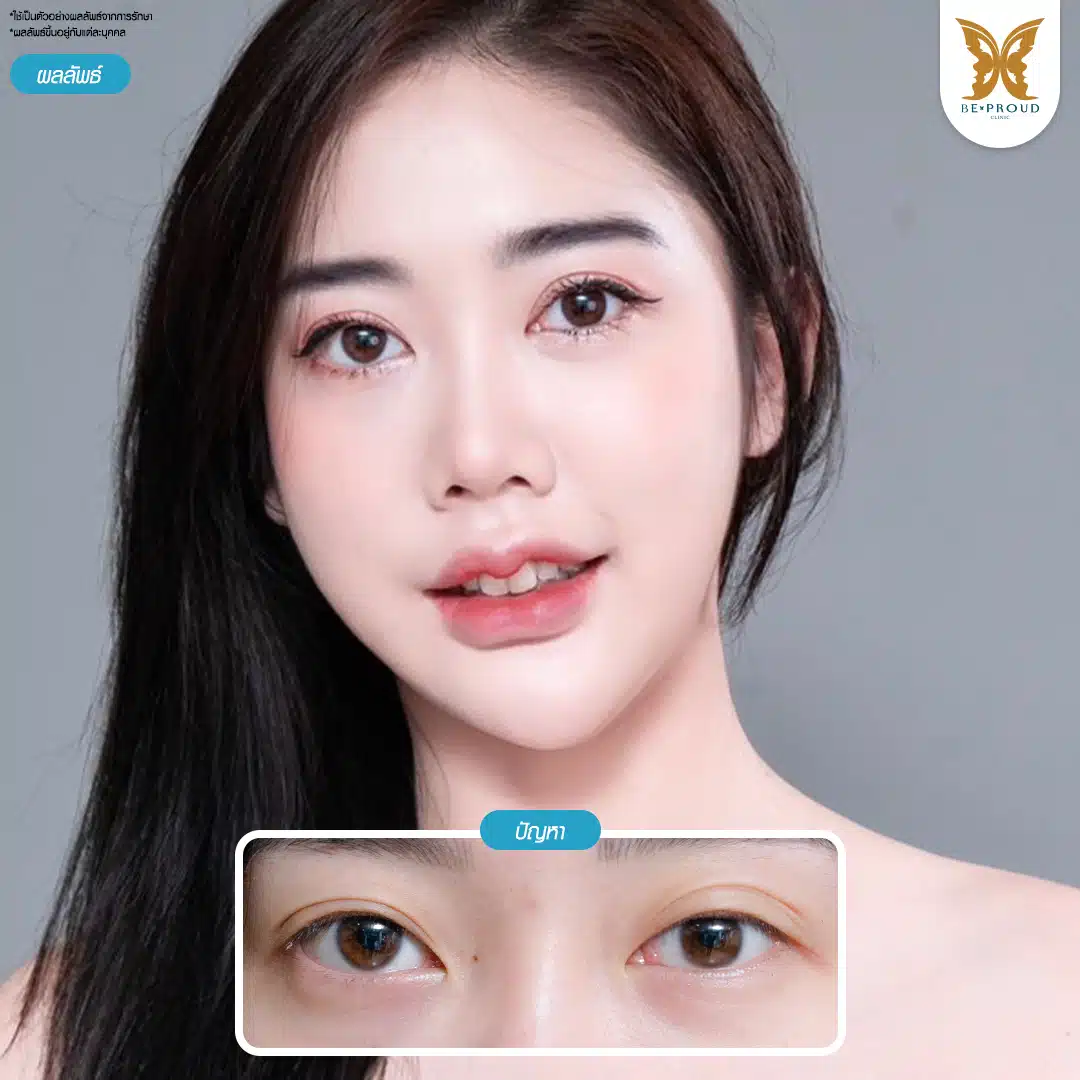 ผ่าตัดรักษากล้ามเนื้อตาอ่อนแรง