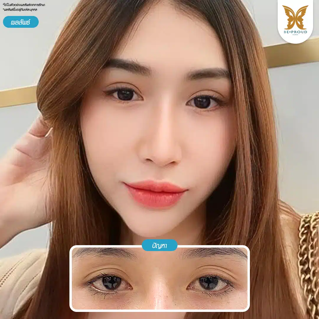 ตาสองชั้น ไม่ผ่าตัดรักษากล้ามเนื้อตาอ่อนแรง