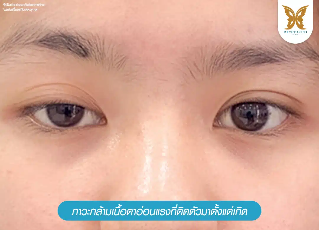 ภาวะกล้ามเนื้อตาอ่อนแรงที่ติดตัวมาตั้งแต่เกิด