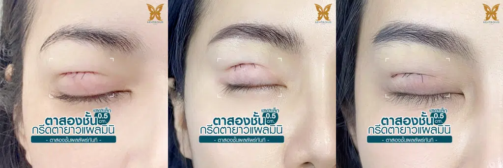 ตาสองชั้นกรีดยาวแผลมินิ