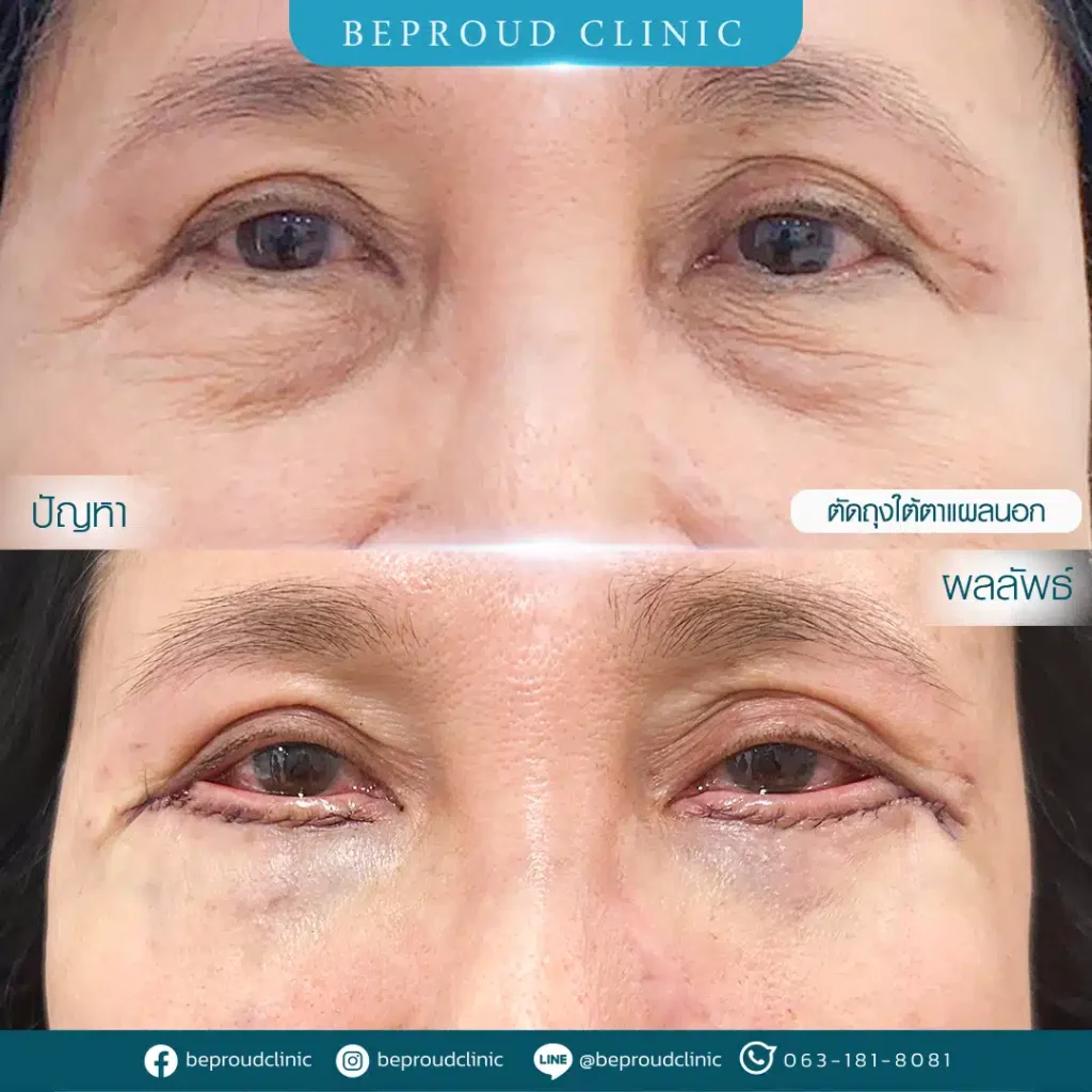 ตัดถุงไขมันใต้ตาแผลนอก