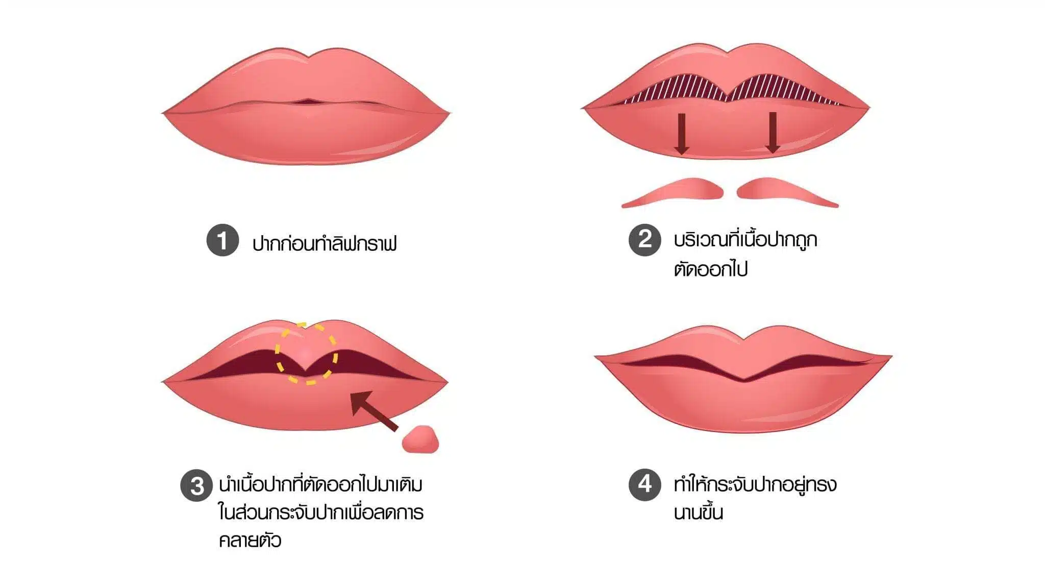 ขั้นตอนการลิปกราฟ