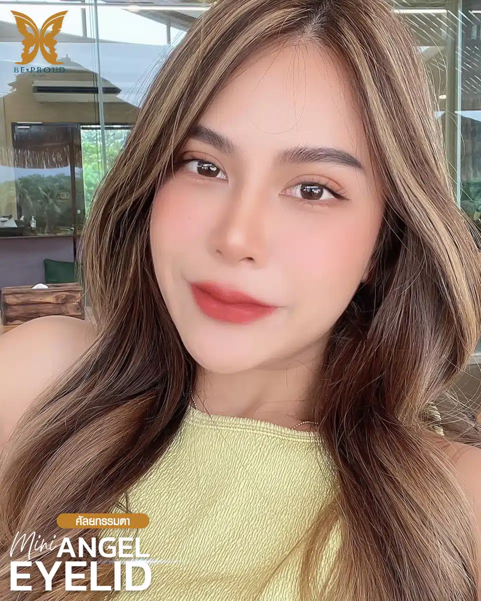 ตาสองชั้นกรีดยาวแผลมินิ