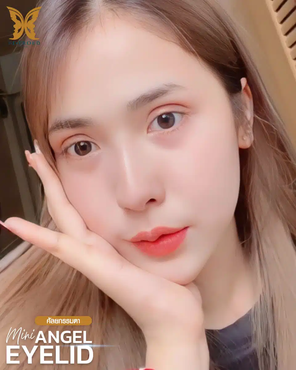 ตาสองชั้นกรีดยาวแผลมินิ