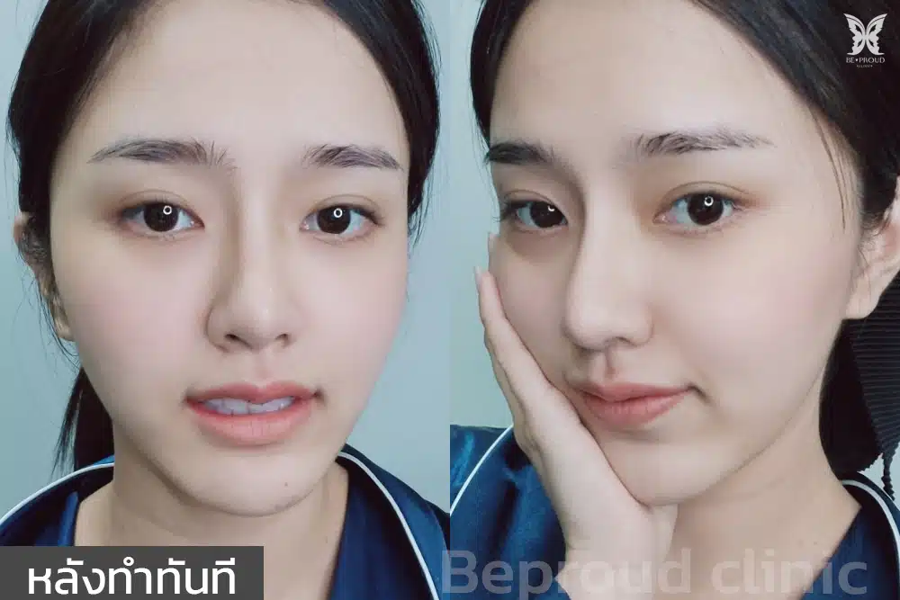 หลังทำตาสองชั้น ปากกระจับ ที่บีพราวด์