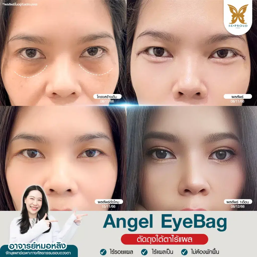 ตัดถุงใต้ตา Angel EyeBag
