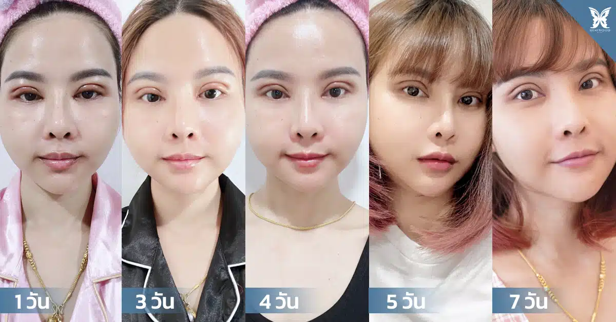 ตาสองชั้นกรีดตายาวแผลมินิ