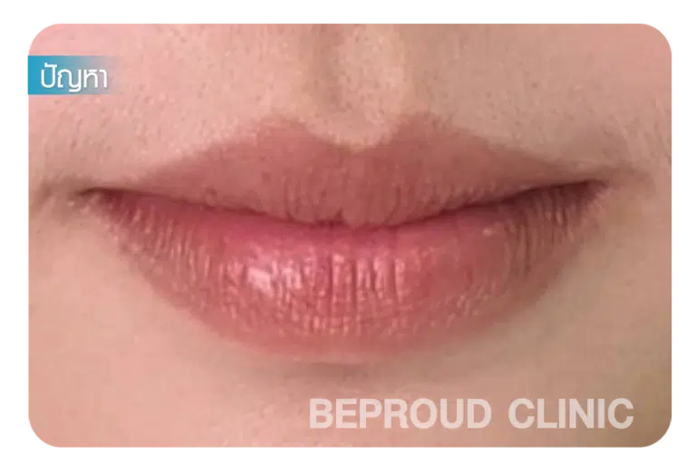 ศัลยกรรมปากกระจับ ปากบาง