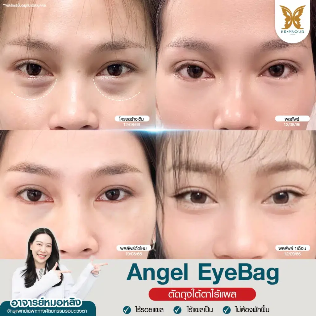 ตัดถุงใต้ตา Angel EyeBag