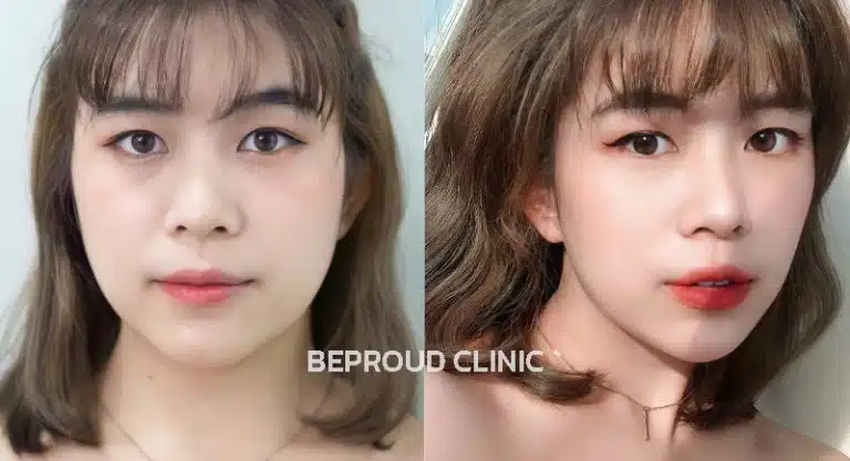 โบท็อกซ์ ลิฟกรอบหน้า  บีพราวด์