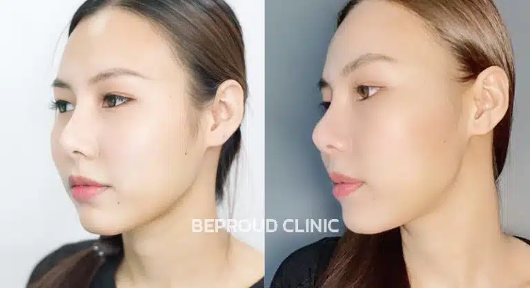 โบท็อกซ์ ลิฟกรอบหน้า  บีพราวด์