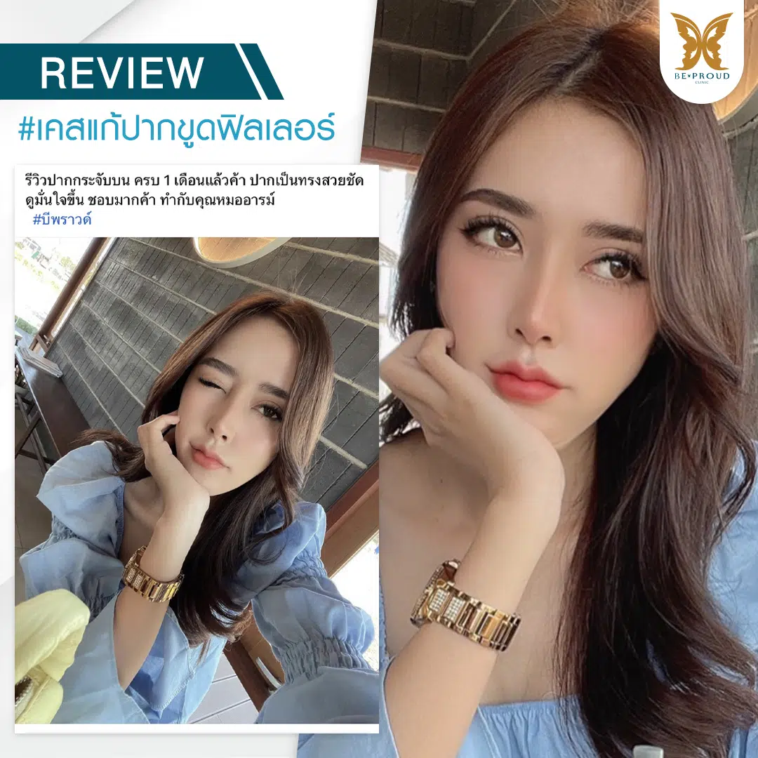 รีวิวแก้ปากขูดฟิลเลอร์