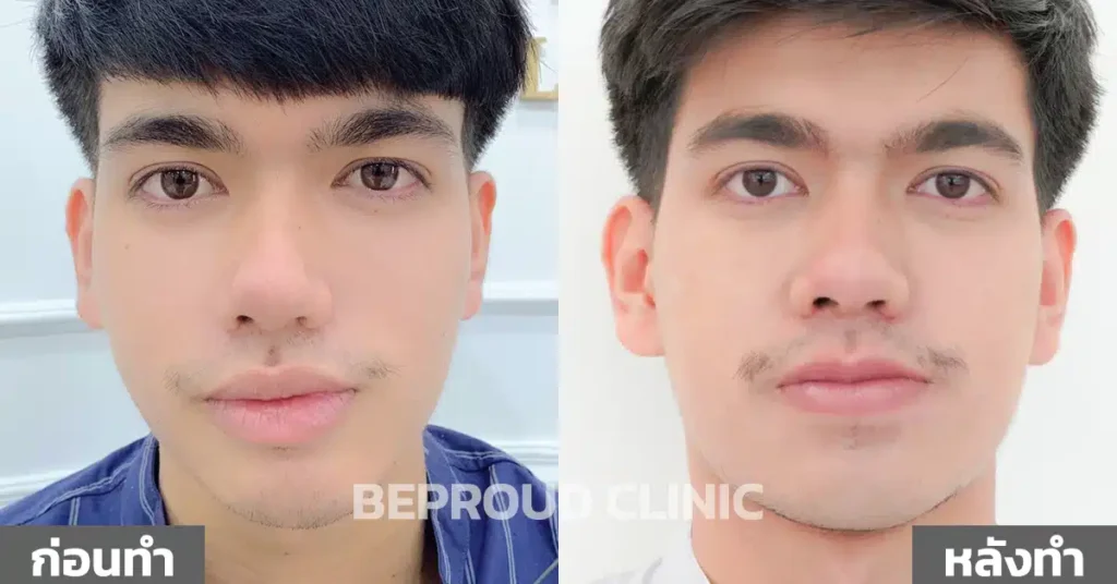 ไตเติ้ล ปากกระจับผู้ชาย บีพราวด์