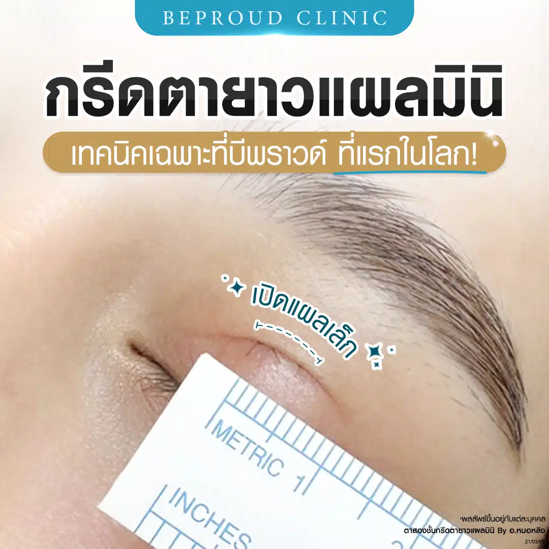 ภาพแสดงการวัดรอยกรีดตาที่เล็กมาก เทคนิคกรีดตายาวแผลมินิ ที่บีพราวด์คลินิก