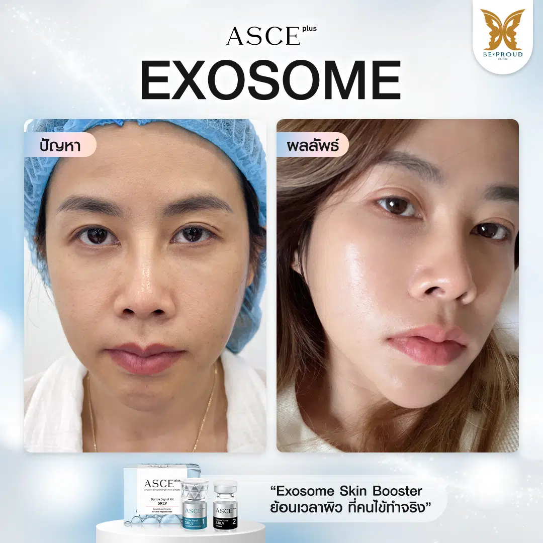 รีวิวหลังฉีด Exosome Skin Booster