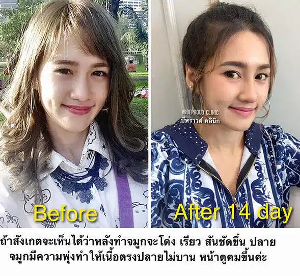 เสริมกระดูกอ่อนหลังหู ตะไบฮัมพ์