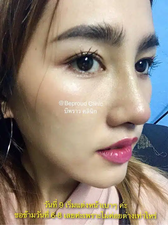 เสริมกระดูกอ่อนหลังหู ตะไบฮัมพ์