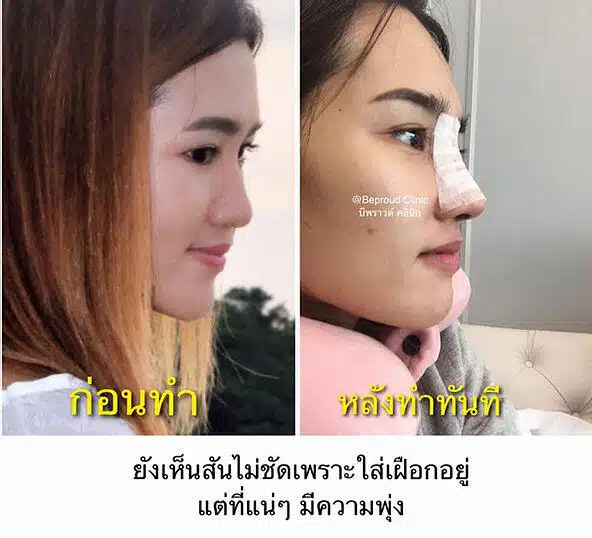 เสริมกระดูกอ่อนหลังหู ตะไบฮัมพ์