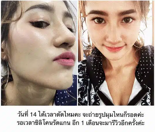 เสริมกระดูกอ่อนหลังหู ตะไบฮัมพ์