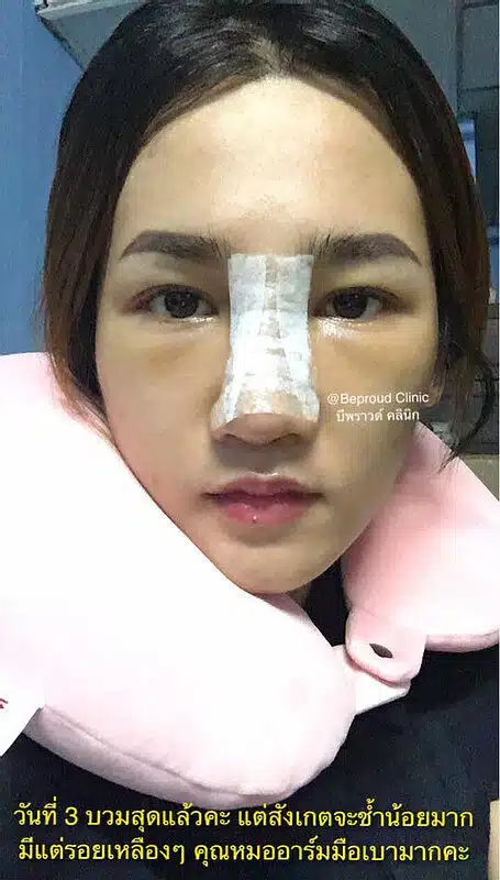 เสริมกระดูกอ่อนหลังหู ตะไบฮัมพ์