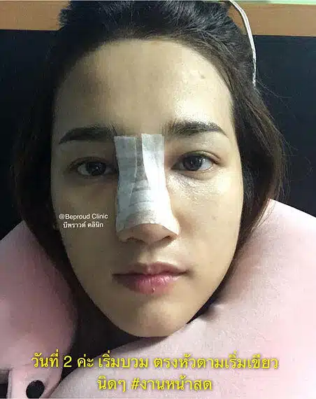 เสริมกระดูกอ่อนหลังหู ตะไบฮัมพ์