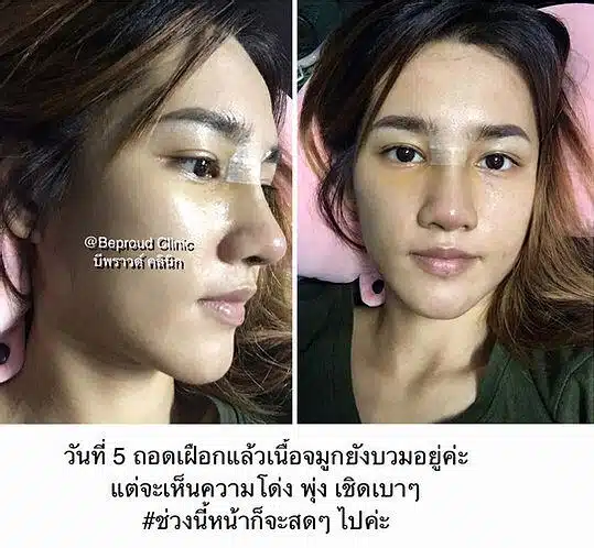 เสริมกระดูกอ่อนหลังหู ตะไบฮัมพ์