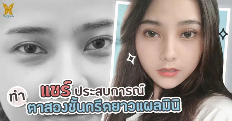 รีวิวตาสองชั้น กรีดยาวแผลมินิ