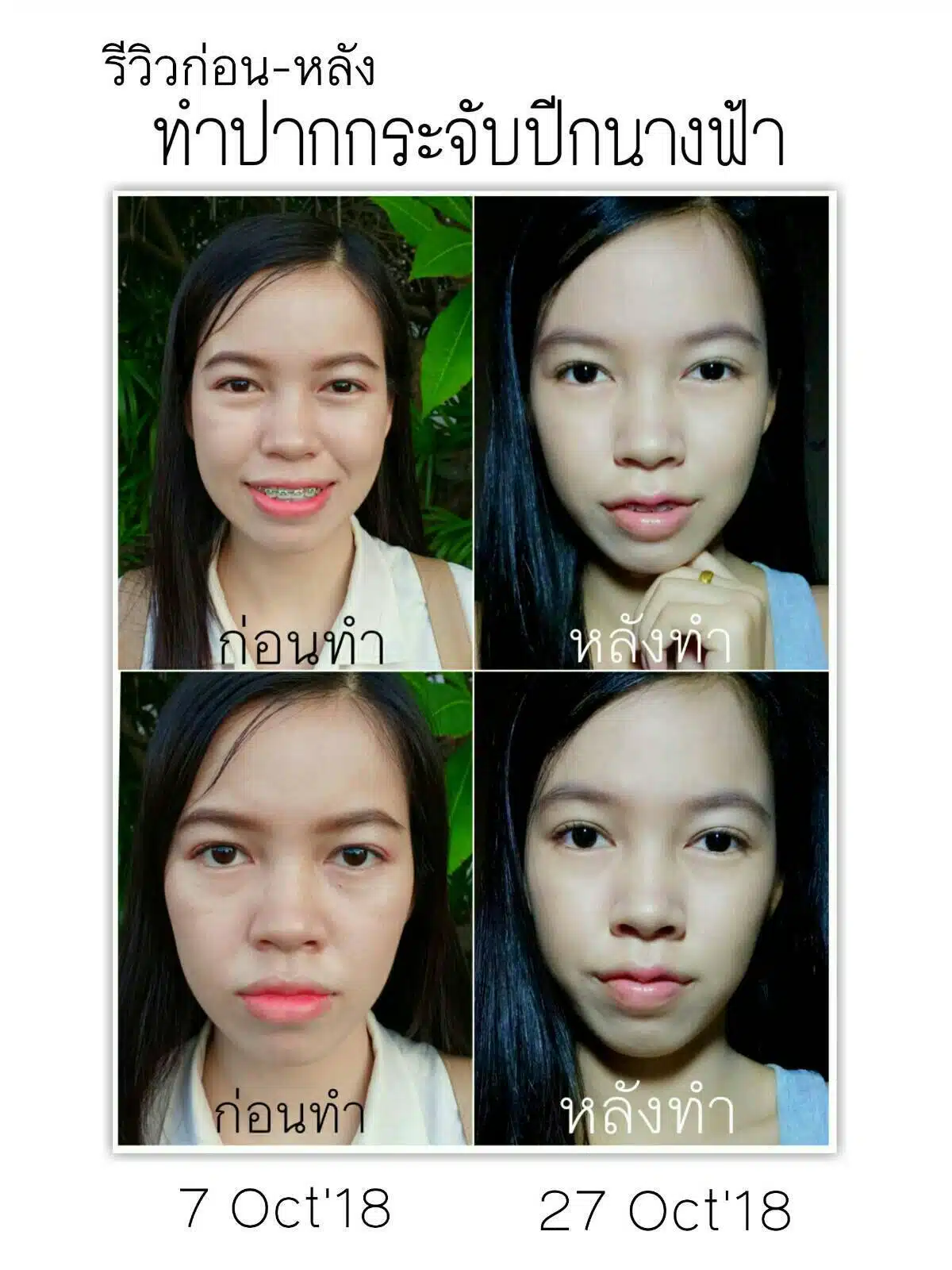 ปากกระจับ บีพราวด์