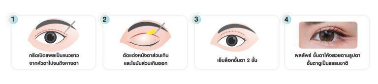 หัตถการตาสองชั้น เทคนิคกรีดยาว บีพราวด์