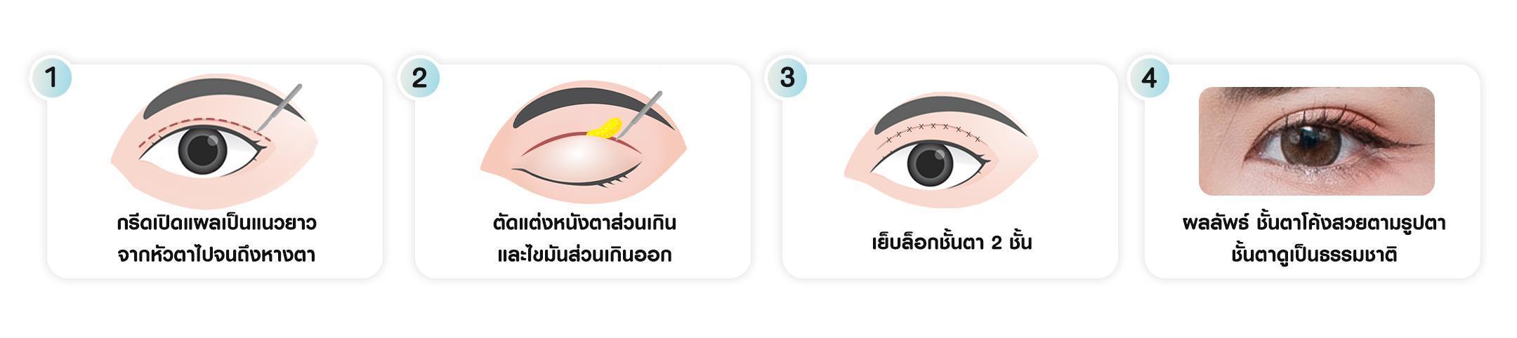 หัตถการตาสองชั้น เทคนิคกรีดยาว บีพราวด์