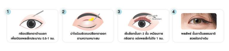 หัตถการตาสองชั้น เทคนิคกรีดยาวแผลมินิ บีพราวด์