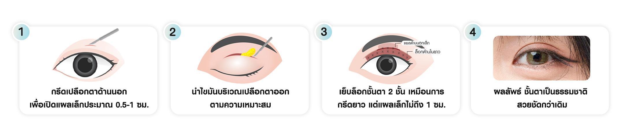 หัตถการตาสองชั้น เทคนิคกรีดยาวแผลมินิ บีพราวด์