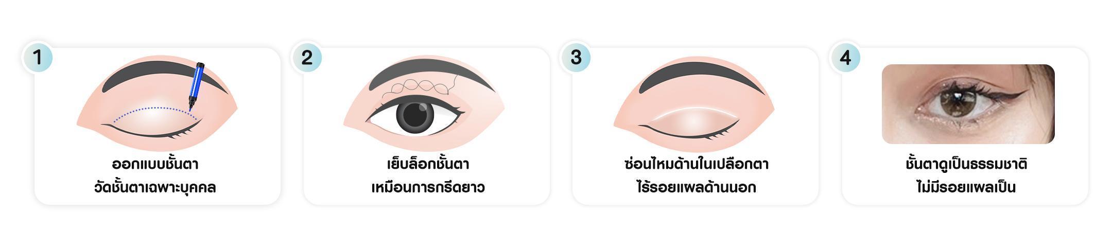หัตถการตาสองชั้นซ่อนแผล บีพราวด์