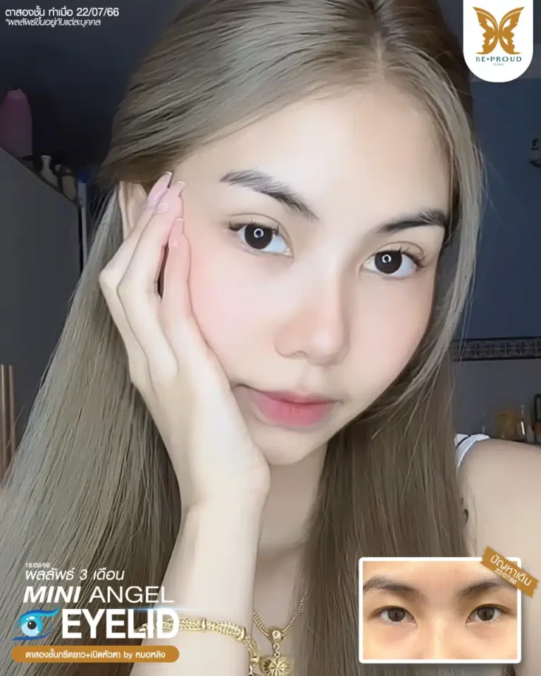 ตาสองชั้นบีพราวด์ คลินิก