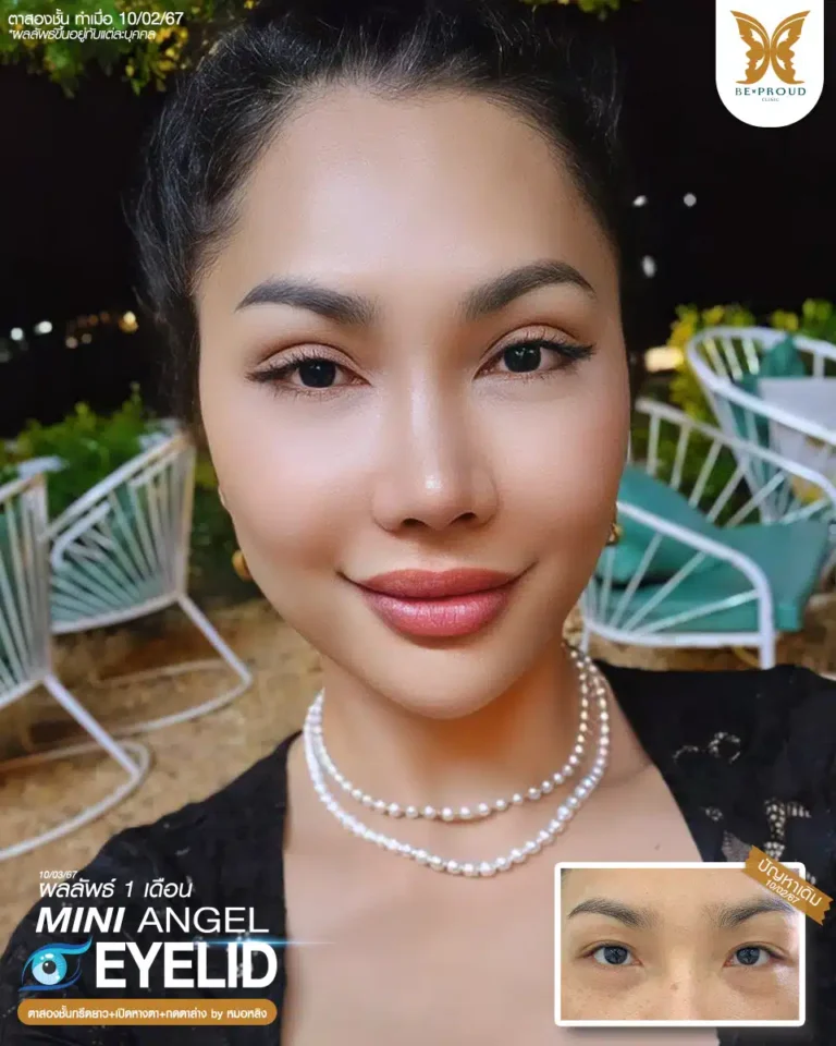ตาสองชั้นบีพราวด์ คลินิก