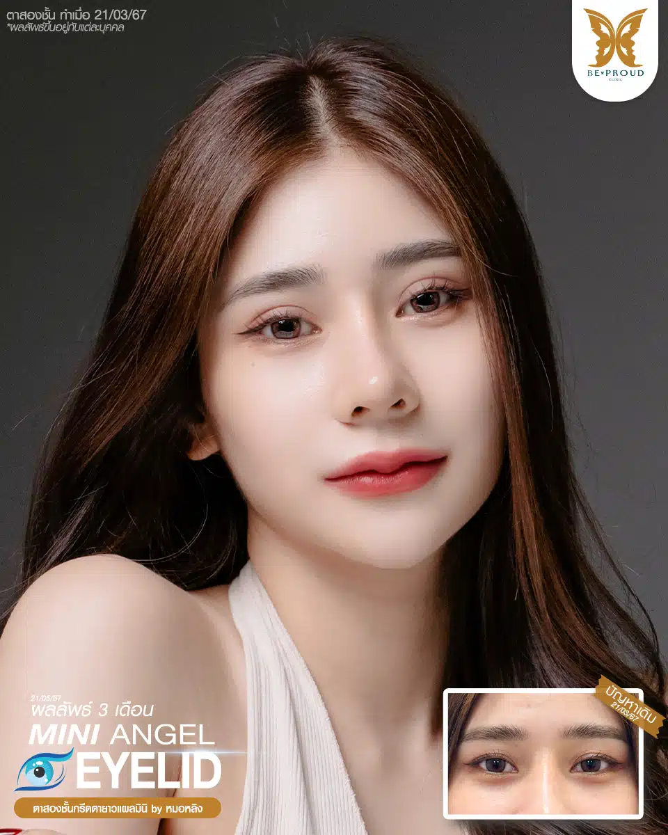 ตาสองชั้นบีพราวด์ คลินิก