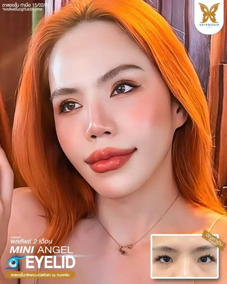 ตาสองชั้นบีพราวด์ คลินิก