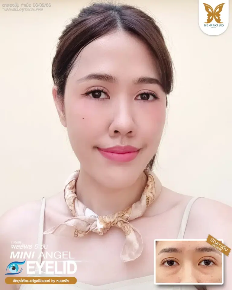 ตาสองชั้นบีพราวด์ คลินิก