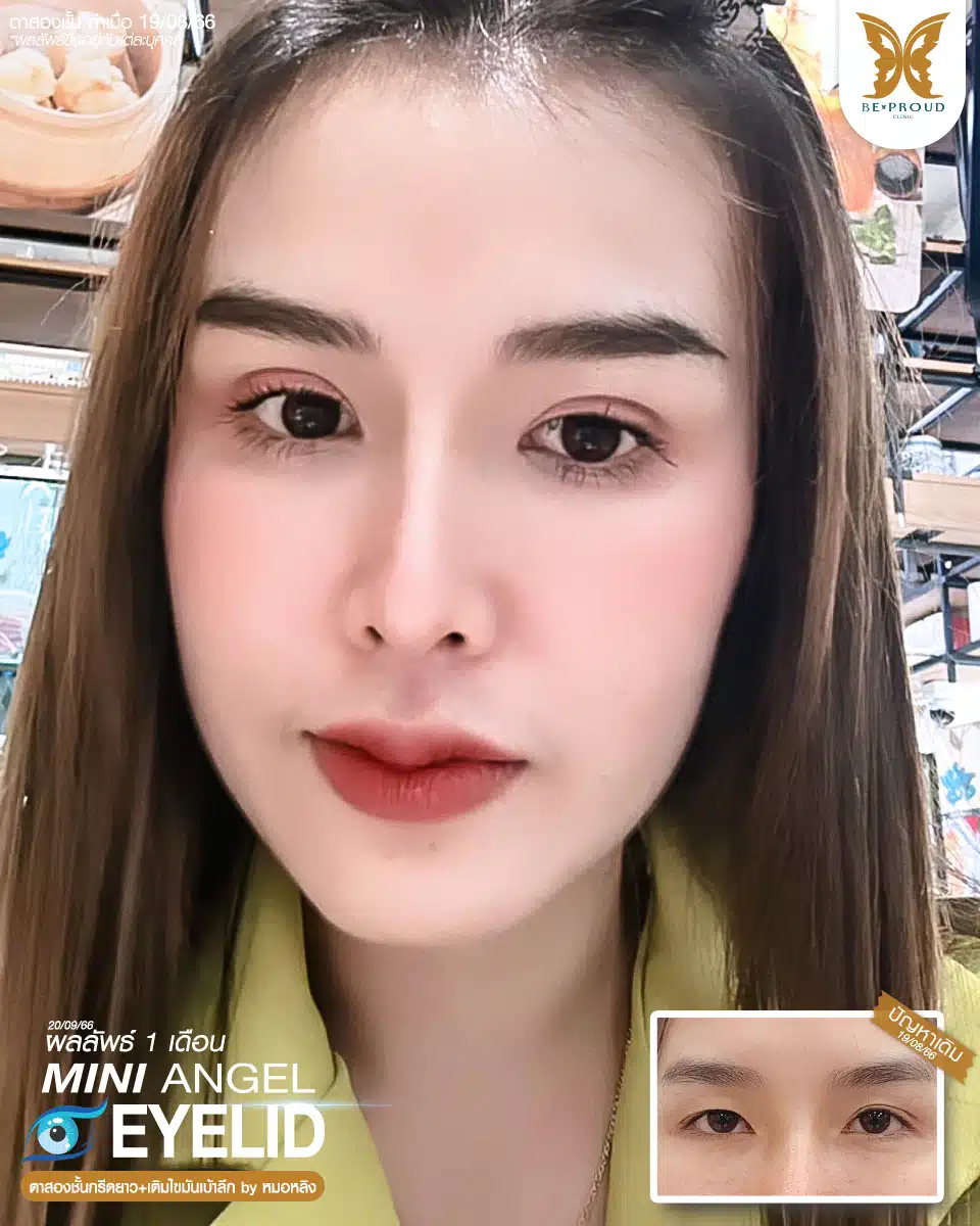 ตาสองชั้นบีพราวด์ คลินิก