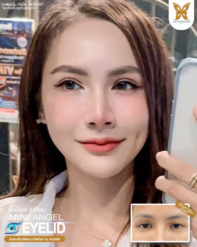 ตาสองชั้นบีพราวด์ คลินิก