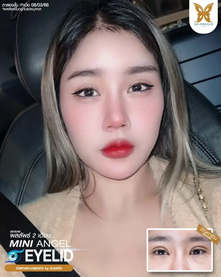 ตาสองชั้นบีพราวด์ คลินิก