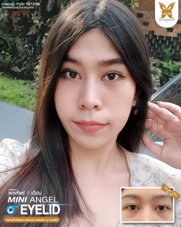 ตาสองชั้นบีพราวด์ คลินิก