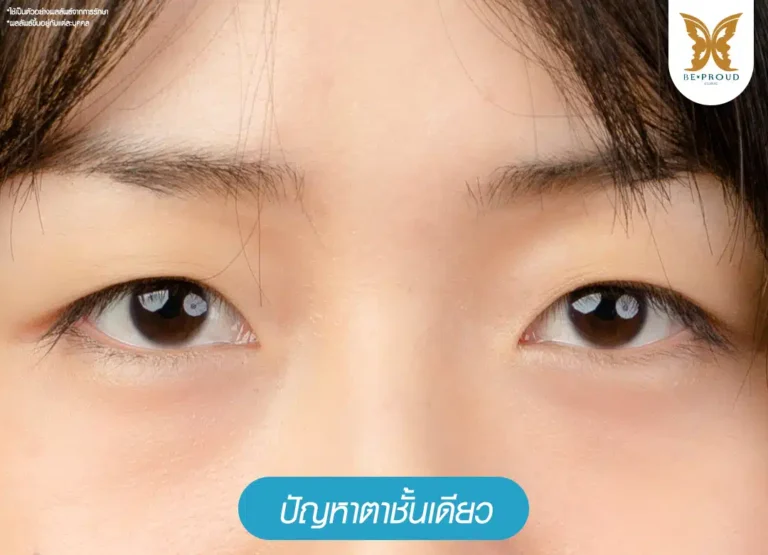 ปัญหาตาชั้นเดียว