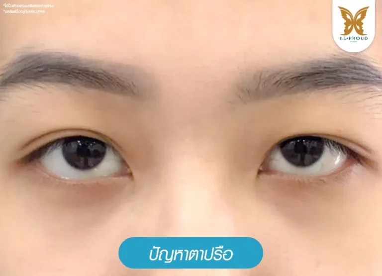 ปัญหาตาปรือ